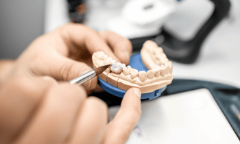 Emax vs. Zirconia Crowns