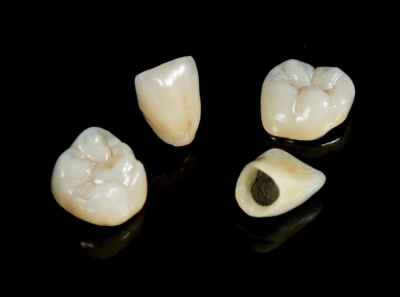 Porcelain Fused to Metal Dental Crown