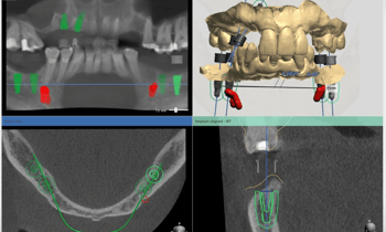  Implant Surgical Guides