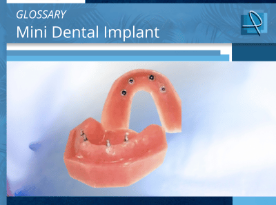 What are Mini Dental Implants? | Pro-Craft