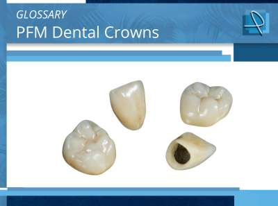 What Is a Porcelain Fused to Metal Dental Crown? | Pro-Craft